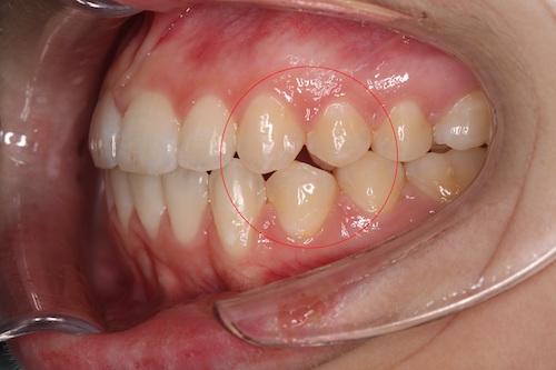 Поставить имплант или перетянуть соседние зубы брекетами на место удаленного — что лучше?